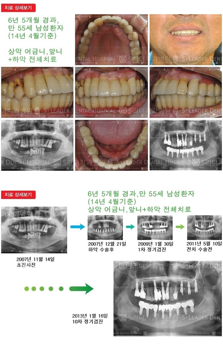 하악 전체, 상악 다수, 18년 10개월 경과 — 추가 사진 (임플란트)