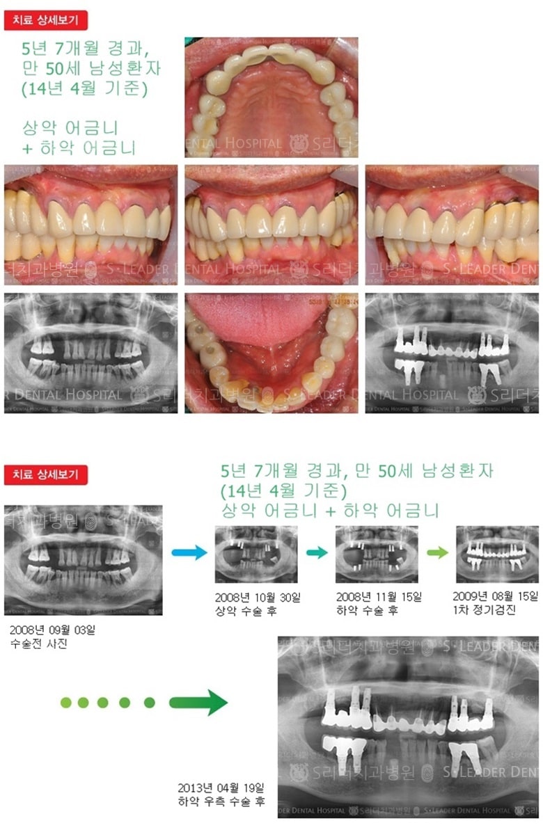상악,하악 어금니 치료, 18년 경과 — 추가 사진 (임플란트)
