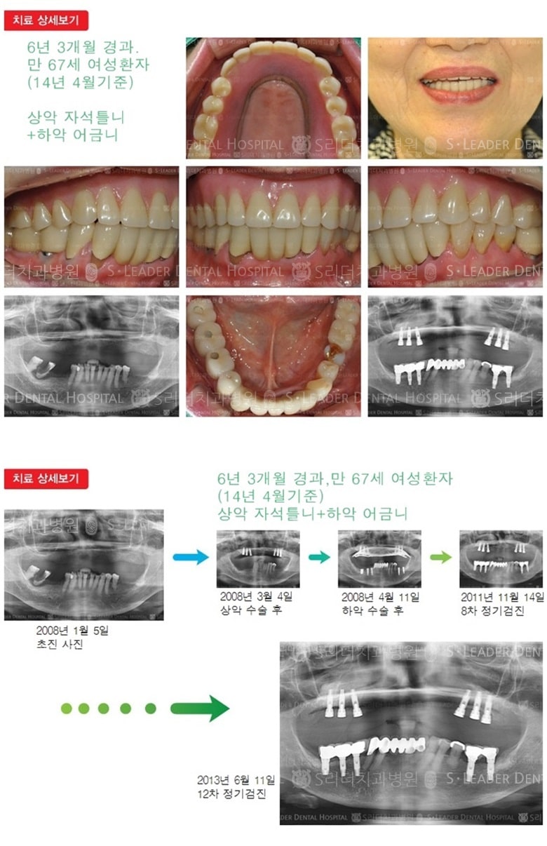 상악 자석틀니, 하악 어금니,18년 8개월경과 — 추가 사진 (임플란트)