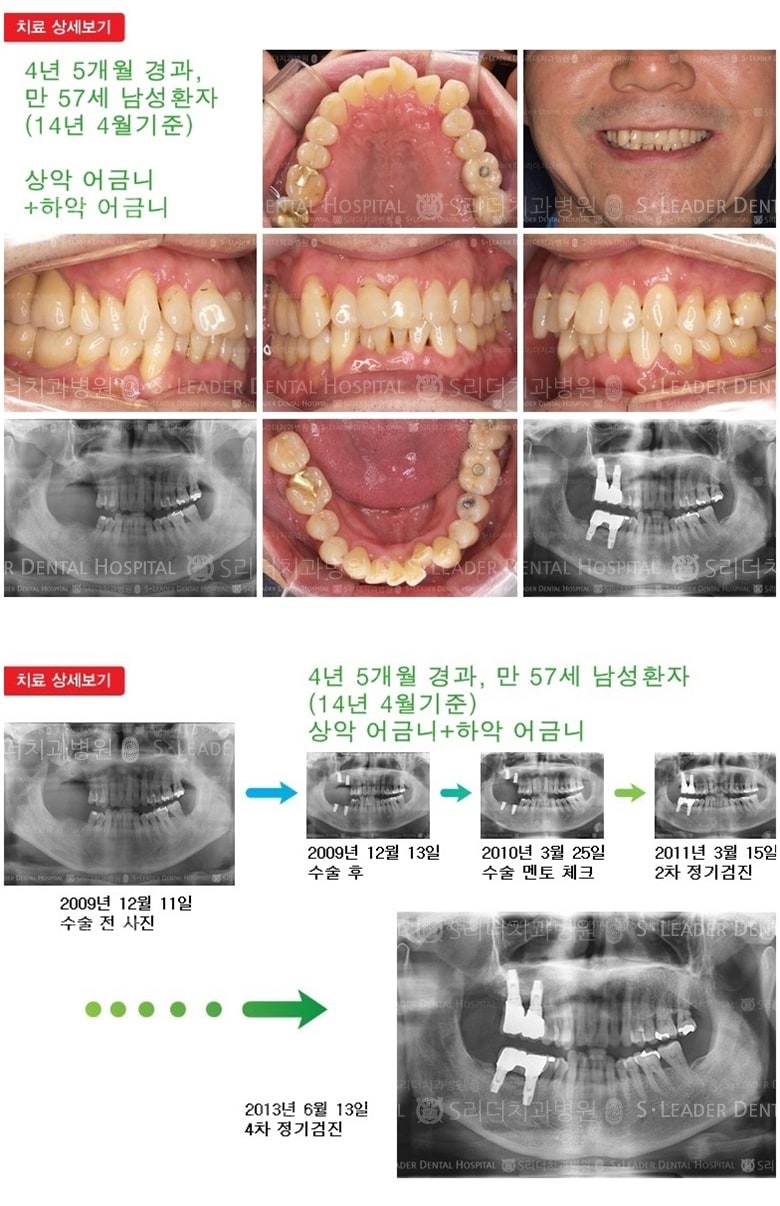 상악어금니, 하악어금니, 16년 10개월 경과 — 추가 사진 (임플란트)