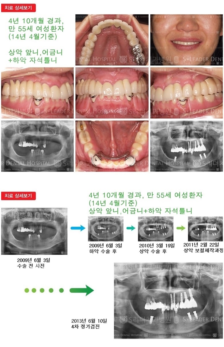 임플란트틀니, 17년 3개월 경과 — 추가 사진 (임플란트)