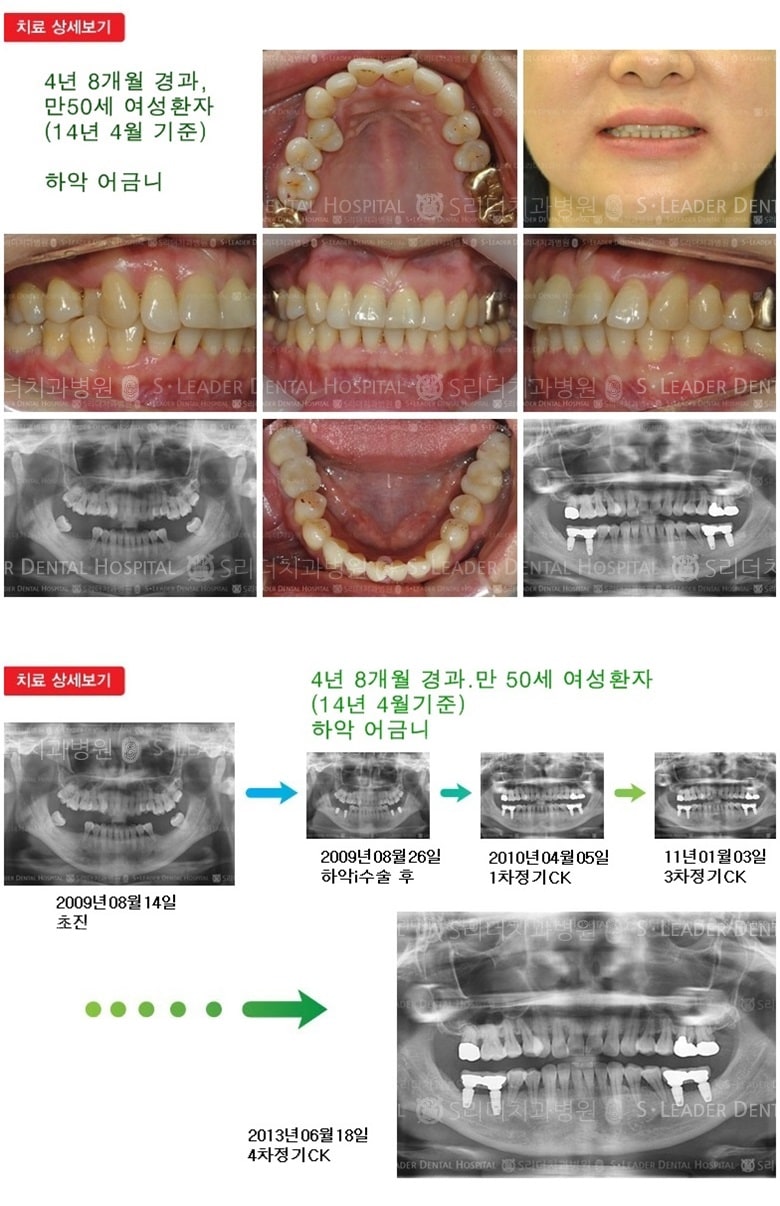 하악 어금니, 17년 1개월 경과 — 추가 사진 (임플란트)