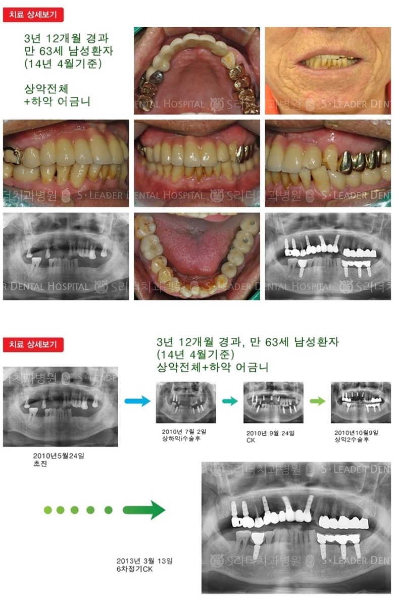 전체임플란트, 어금니임플란트, 16년 5개월 경과 — 추가 사진 (임플란트)