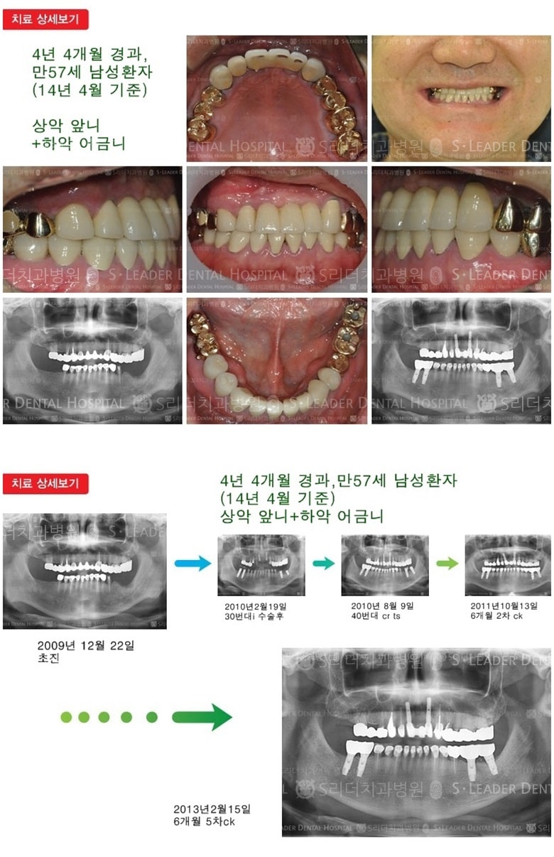상악 앞니, 하악 어금니, 16년 9개월 경과 — 추가 사진 (임플란트)