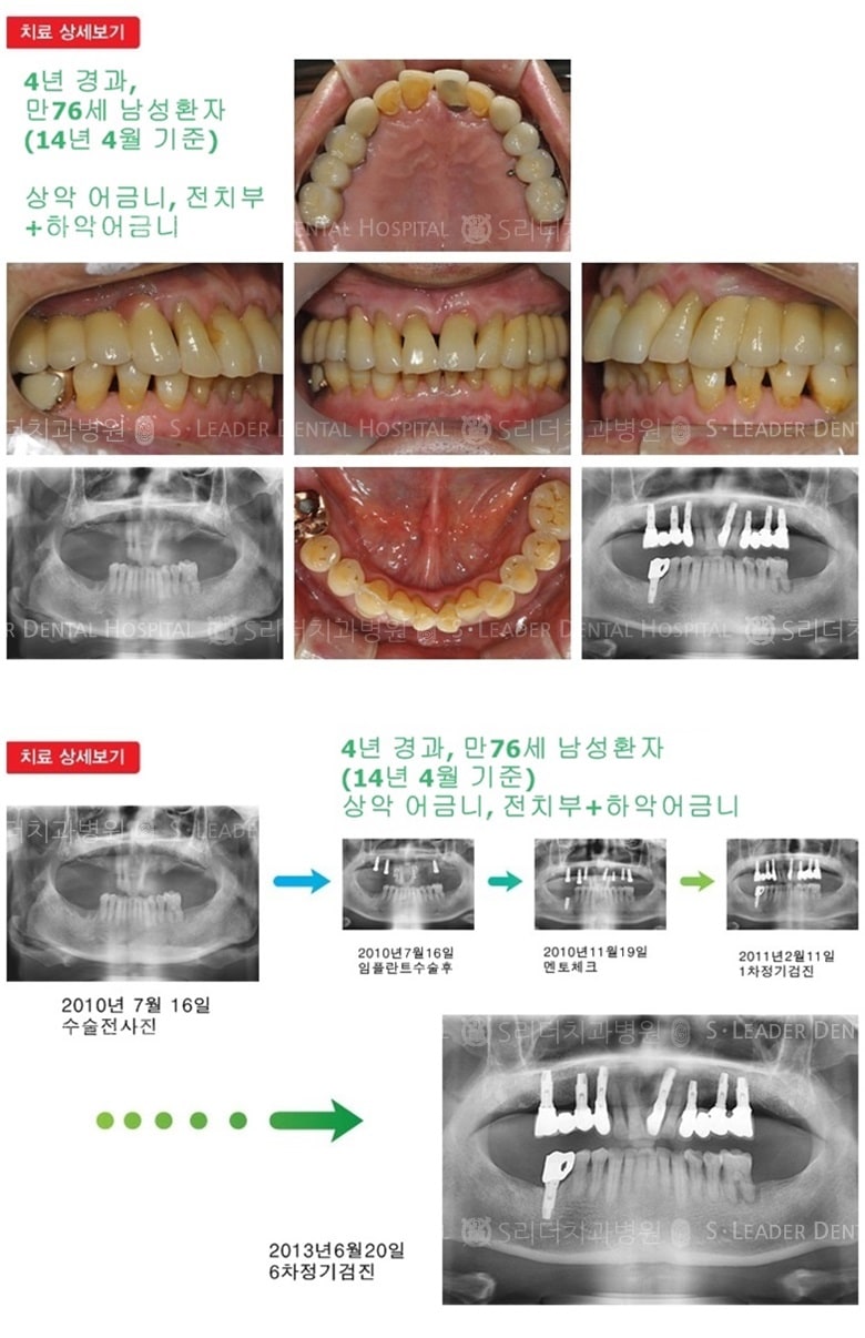 65세이상임플란트, 만76세, 16년 5개월 경과 — 추가 사진 (임플란트)