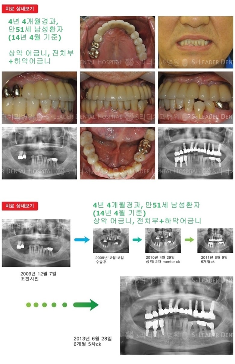 어금니임플란트,전치부임플란트,16년 9개월 — 추가 사진 (임플란트)