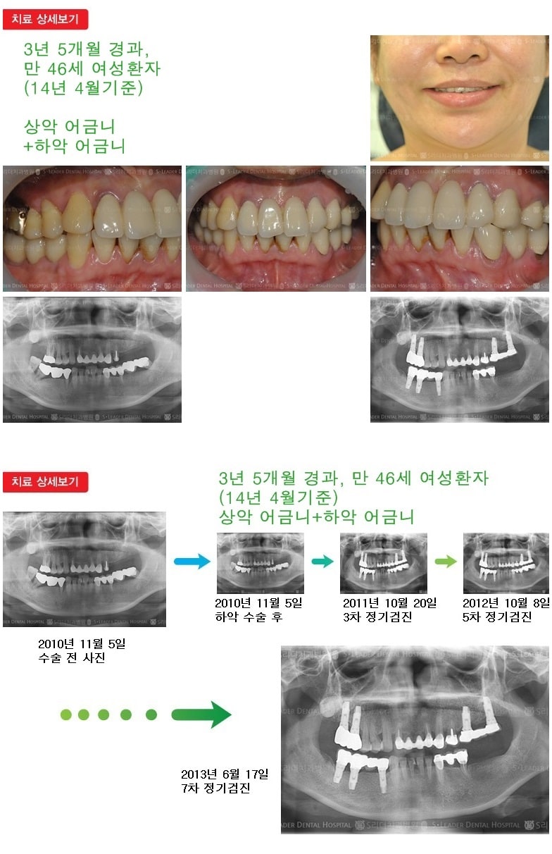 어금니임플란트, 15년 10개월 경과 — 추가 사진 (임플란트)