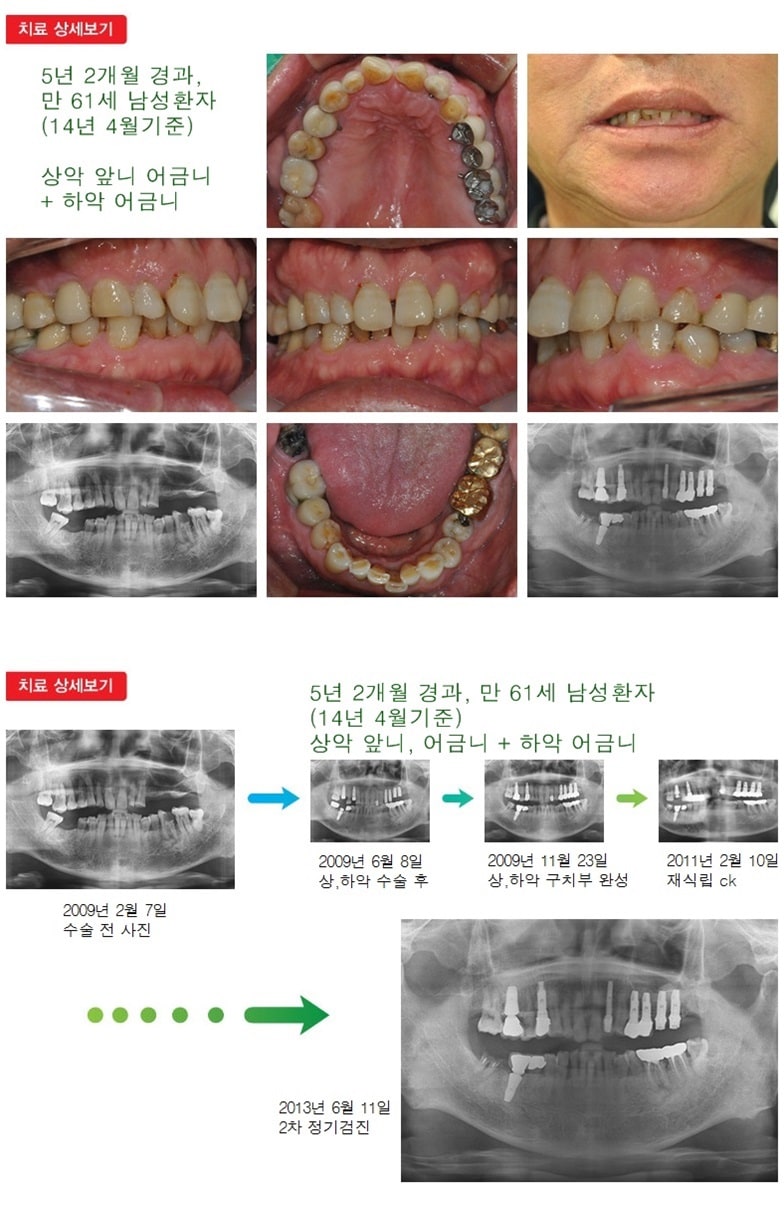 앞니임플란트,어금니임플란트, 17년 7개월 — 추가 사진 (임플란트)
