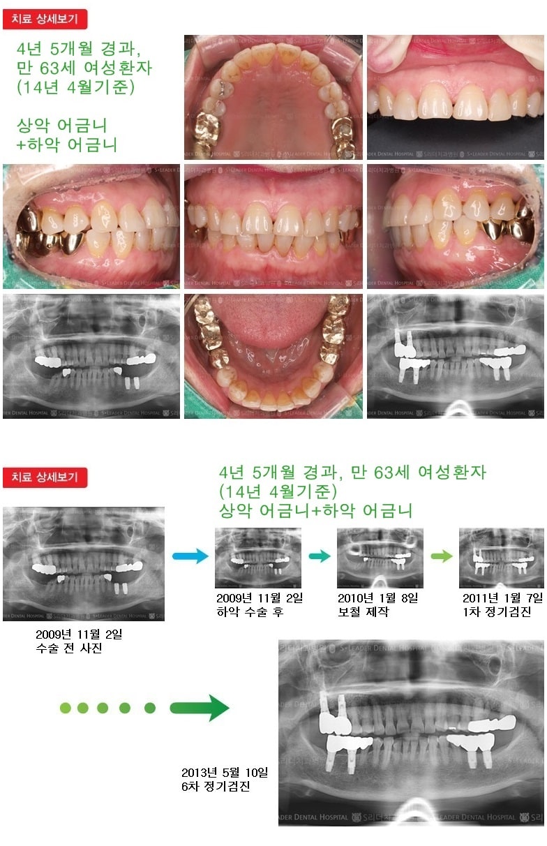 어금니임플란트, 16년 10개월 경과 — 추가 사진 (임플란트)