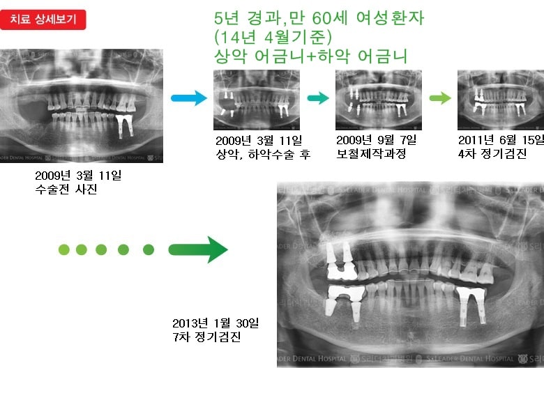 어금니임플란트, 17년 5개월 경과 — 추가 사진 (임플란트)