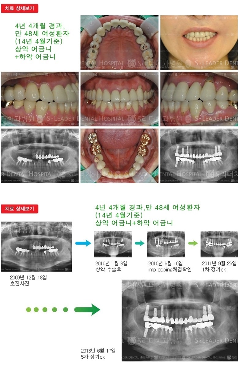 상악어금니,하악어금니,16년 9개월 경과 — 추가 사진 (임플란트)