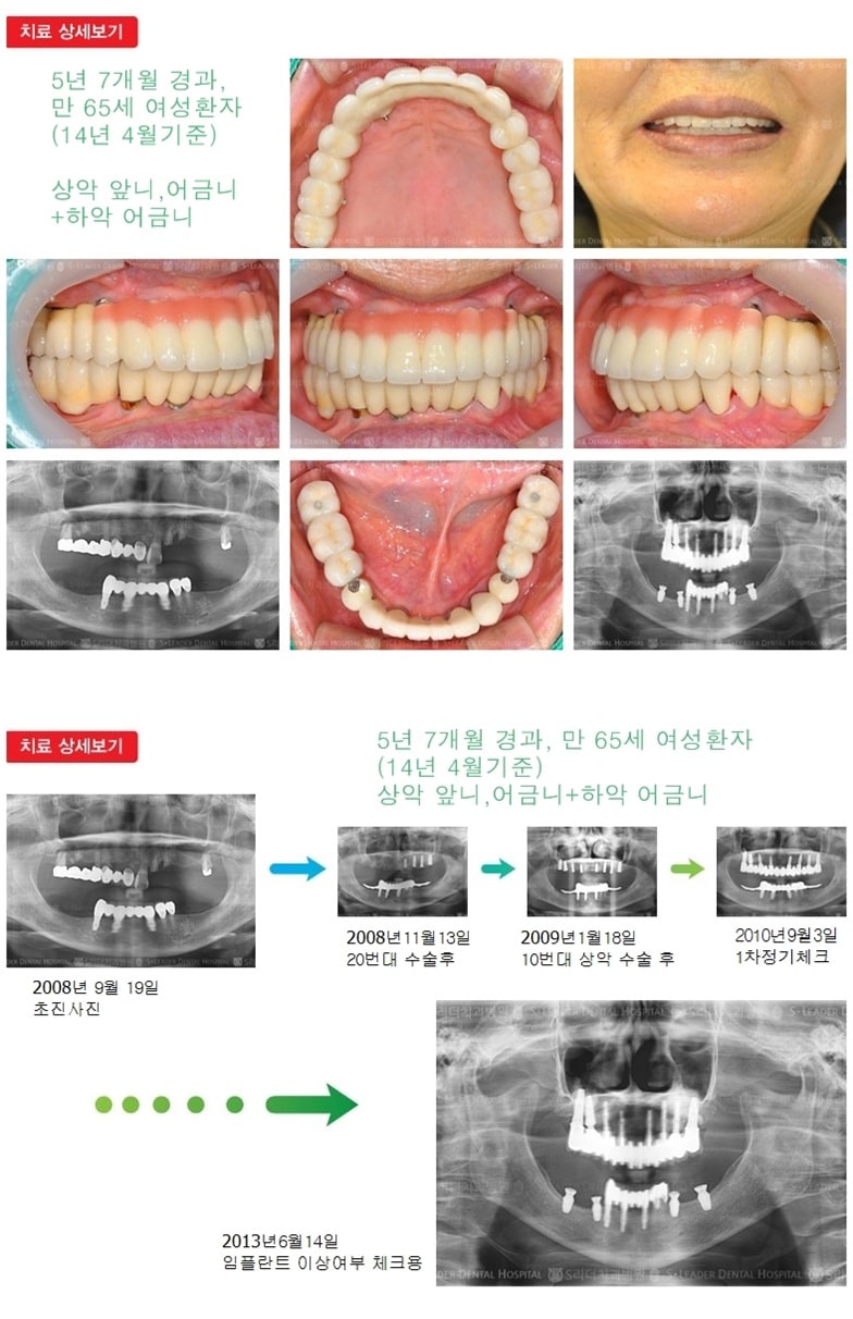 상악 앞니,어금니 하악 어금니 — 추가 사진 (임플란트)