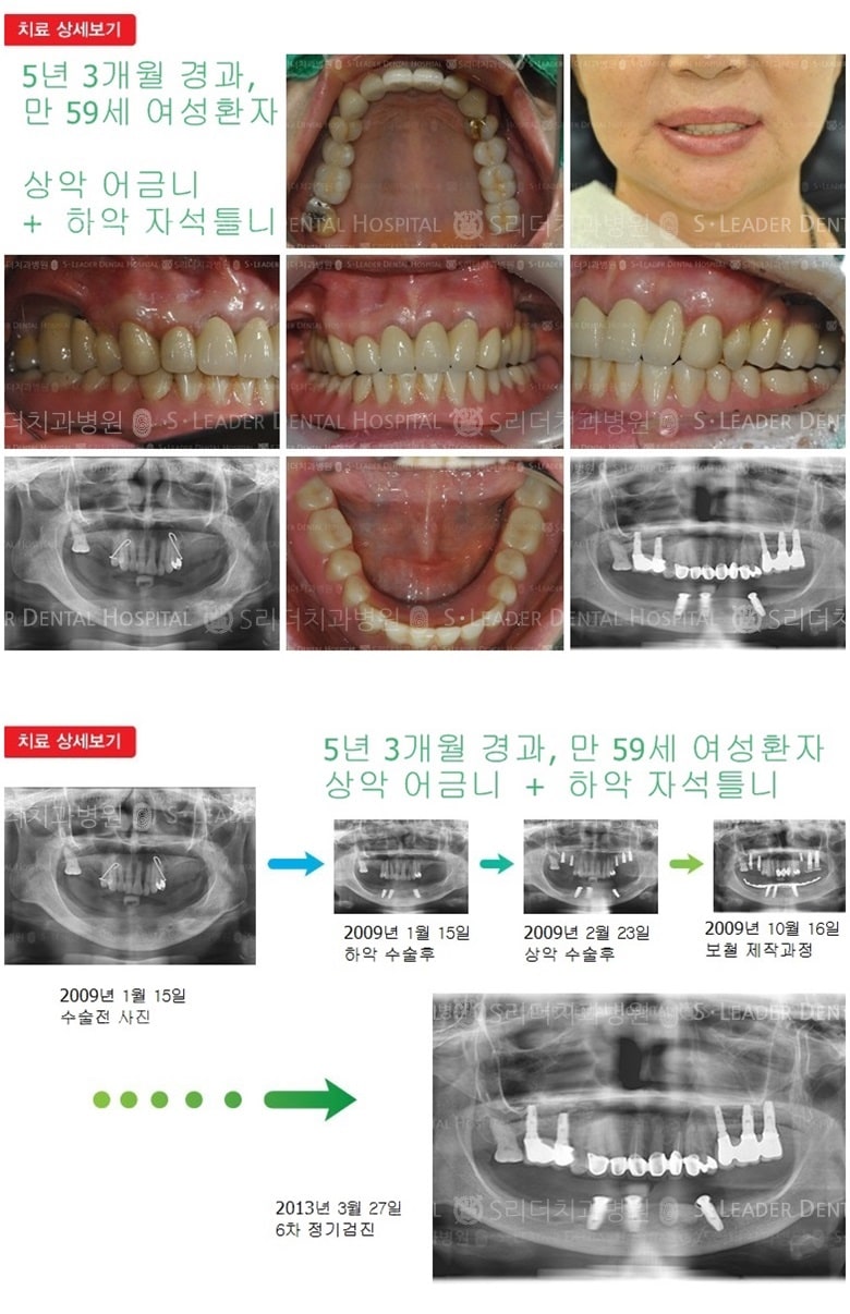 상악어금니, 하악 자석틀니 — 추가 사진 (임플란트)