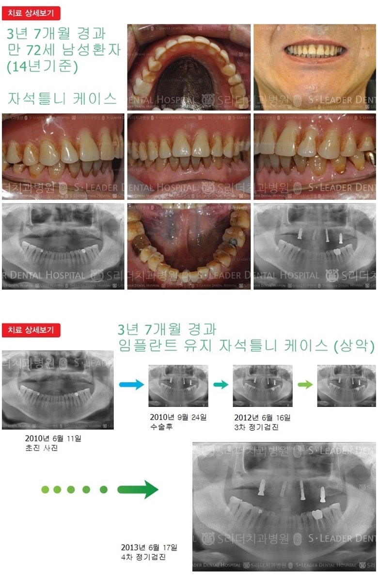 임플란트틀니, 13년 7개월 경과 — 추가 사진 (임플란트)