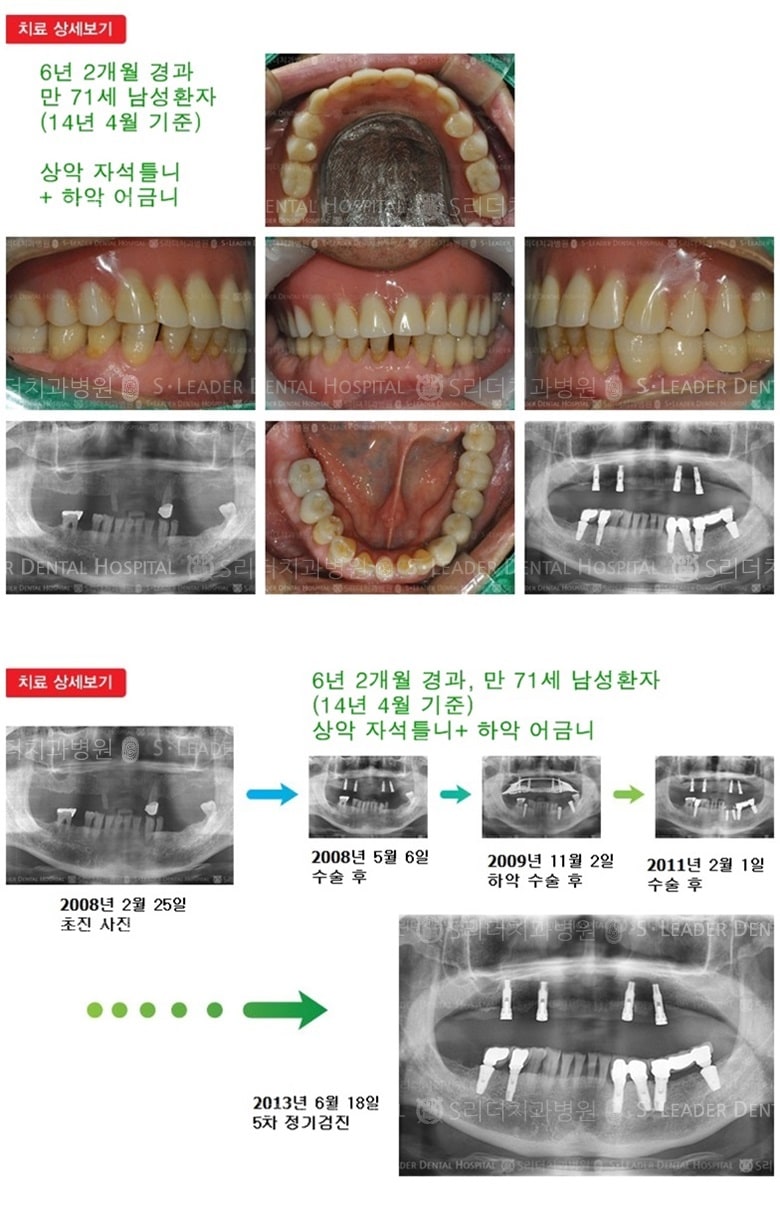 틀니임플란트,어금니임플란트,18년 7개월 경과 — 추가 사진 (임플란트)