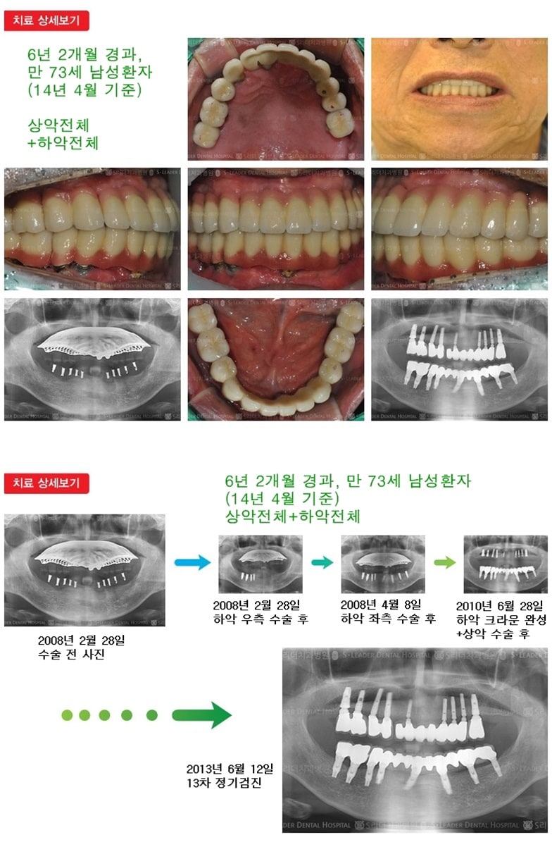 상악 전체, 하악 전체 18년 7개월경과 — 추가 사진 (임플란트)