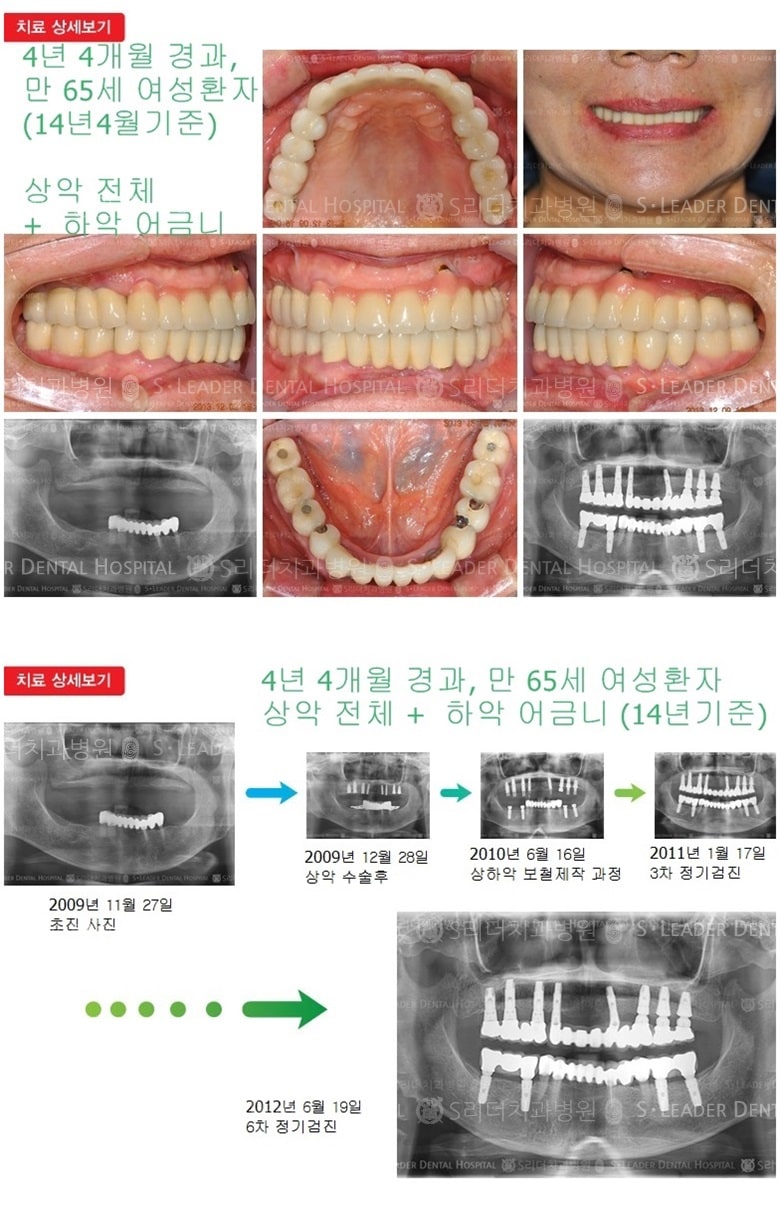 상악 전체, 하악 어금니 치료 — 추가 사진 (임플란트)