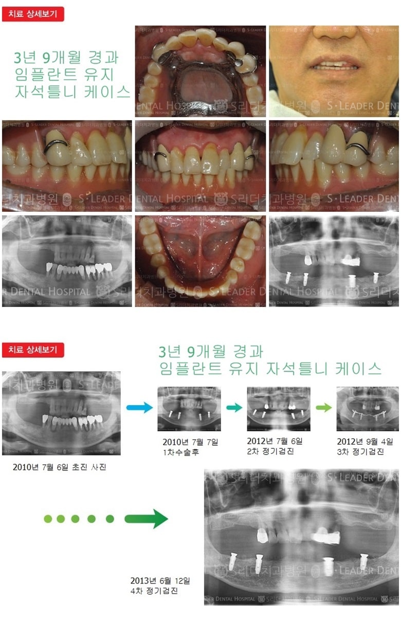 임플란트 유지 자석틀니 — 추가 사진 (임플란트)