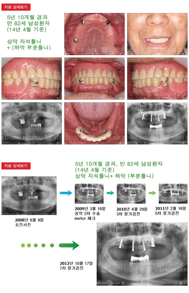 틀니임플란트,부분틀니,18년 3개월 경과 — 추가 사진 (임플란트)