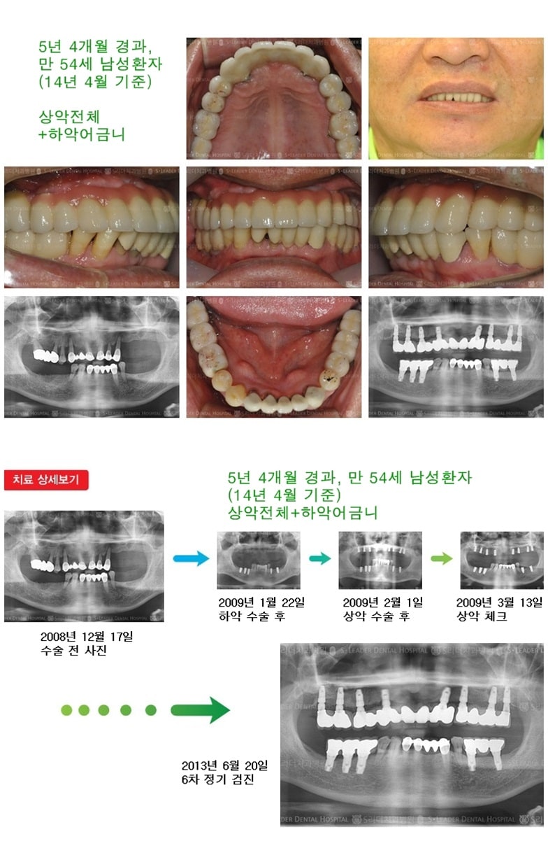 상악 어금니, 하악어금니 17년 9개월경과 — 추가 사진 (임플란트)