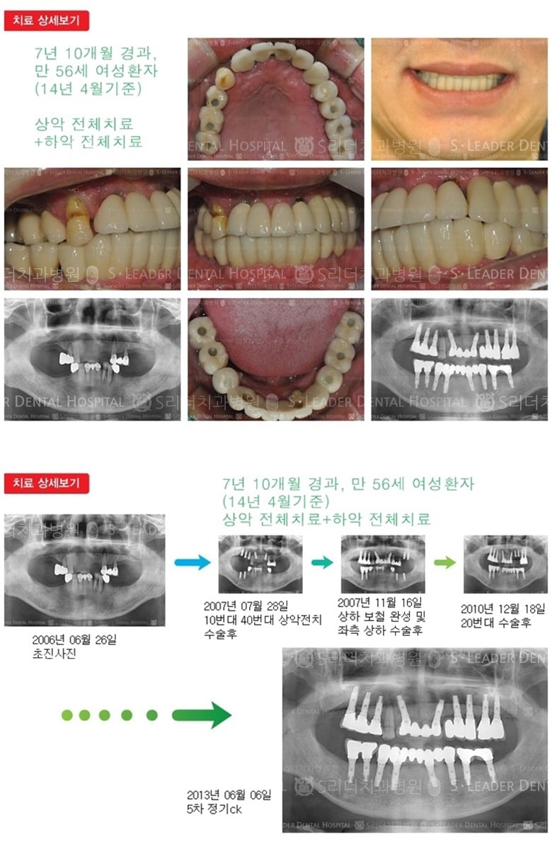 전체임플란트, 20년 3개월 경과 — 추가 사진 (임플란트)