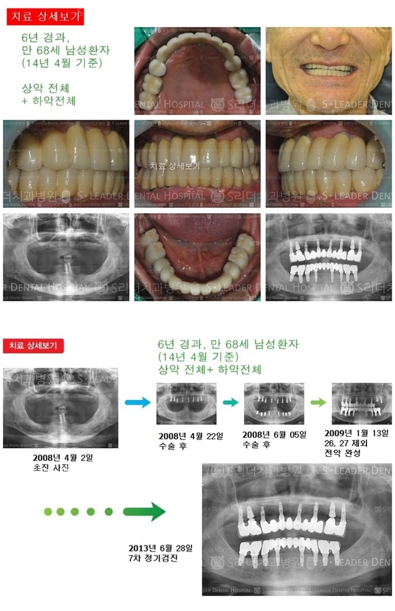 상악전체, 하악전체 18년 5개월 경과 — 추가 사진 (임플란트)