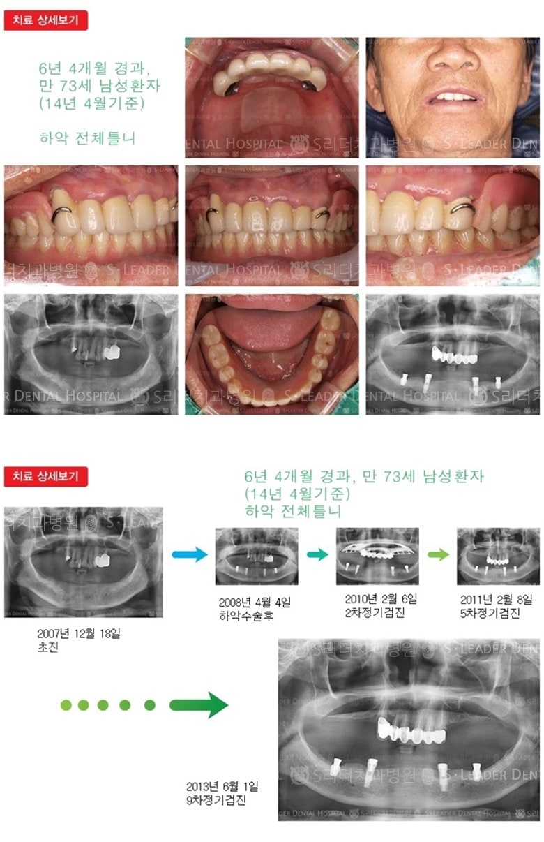 임플란트틀니, 전체틀니, 18년 9개월 경과 — 추가 사진 (임플란트)