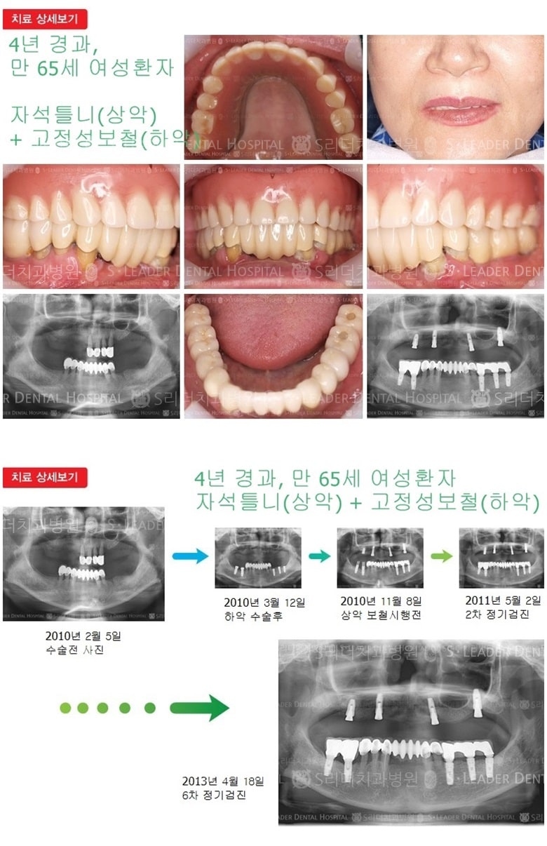 상악 임플란트 자석틀니, 하악 어금니임플란트 — 추가 사진 (임플란트)