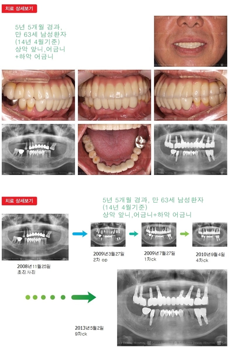상악 전체, 하악 어금니 치료 — 추가 사진 (임플란트)