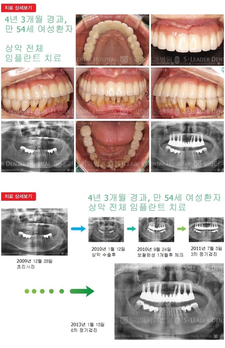 전체임플란트, 16년 8개월 경과 — 추가 사진 (임플란트)
