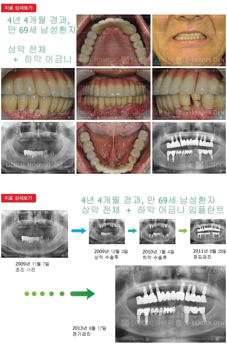 상악 전체, 하악 어금니 치료 — 추가 사진 (임플란트)
