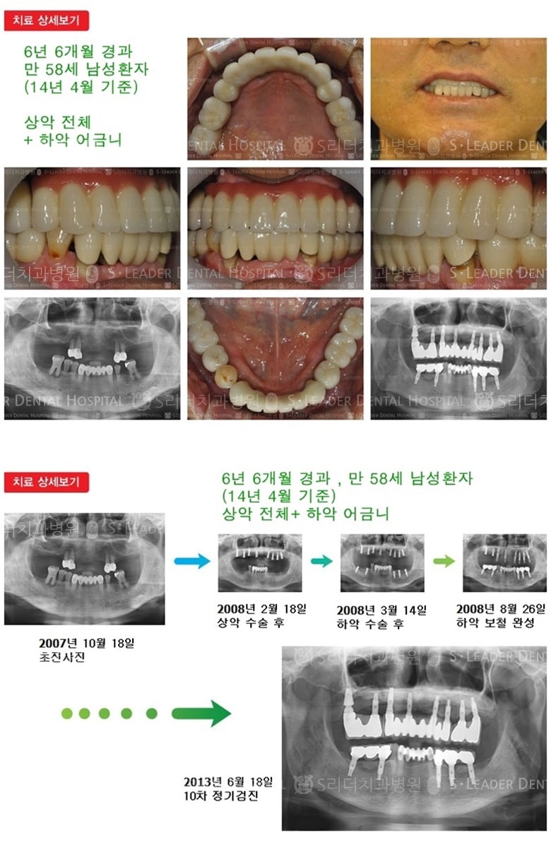 상악전체,하악어금니, 18년 11개월 경과 — 추가 사진 (임플란트)