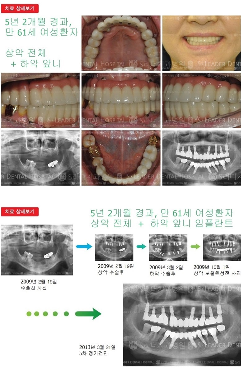 상악 전체, 하악 앞니 치료 — 추가 사진 (임플란트)