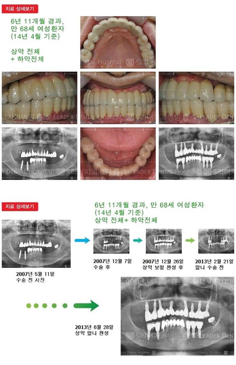 상악전체, 하악전체,19년 4개월 경과 — 추가 사진 (임플란트)