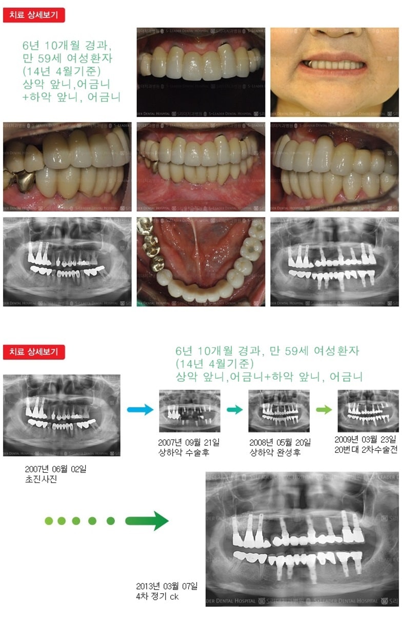 상악 전체, 하악 전체 19년 3개월경과 — 추가 사진 (임플란트)