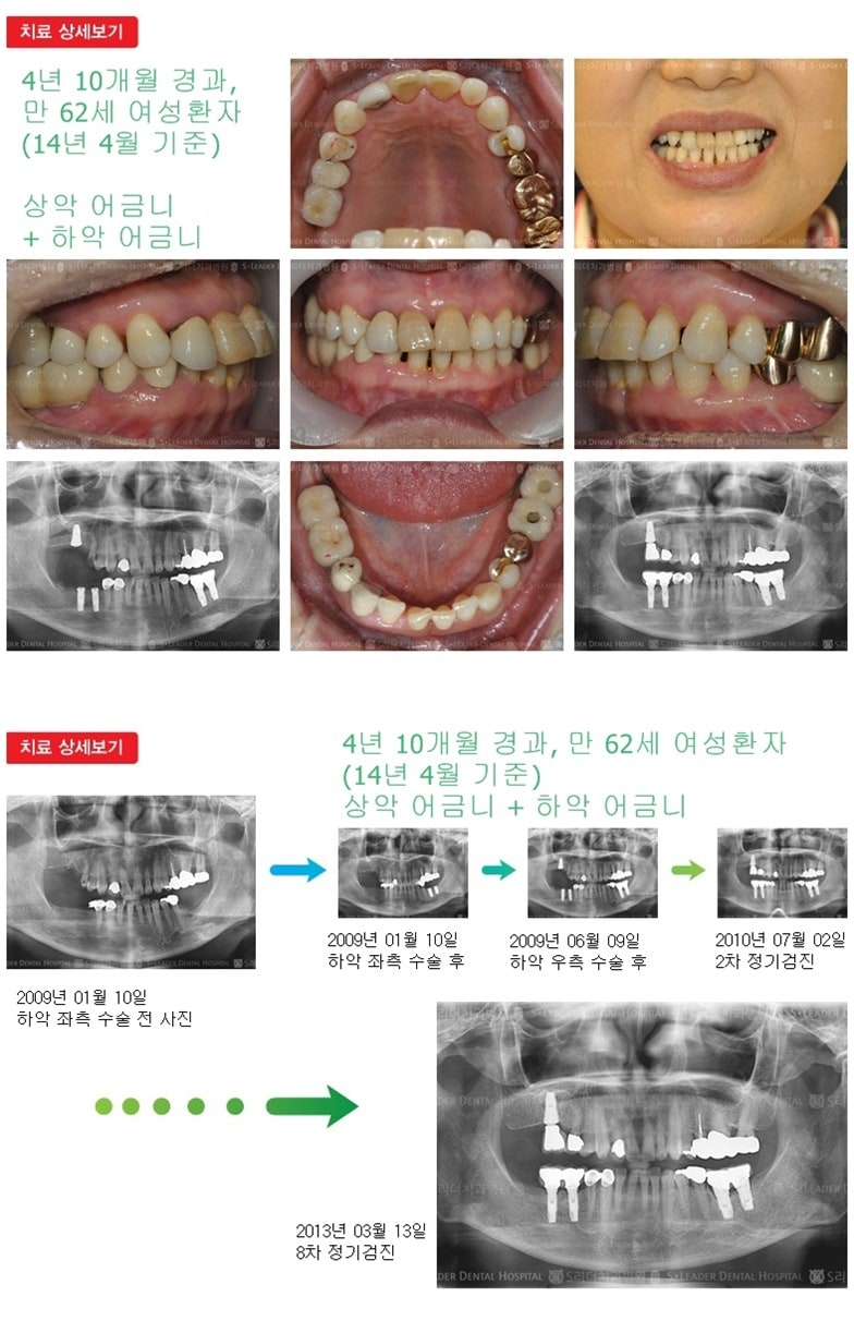 상악어금니,하악어금니,17년 3개월경과 — 추가 사진 (임플란트)