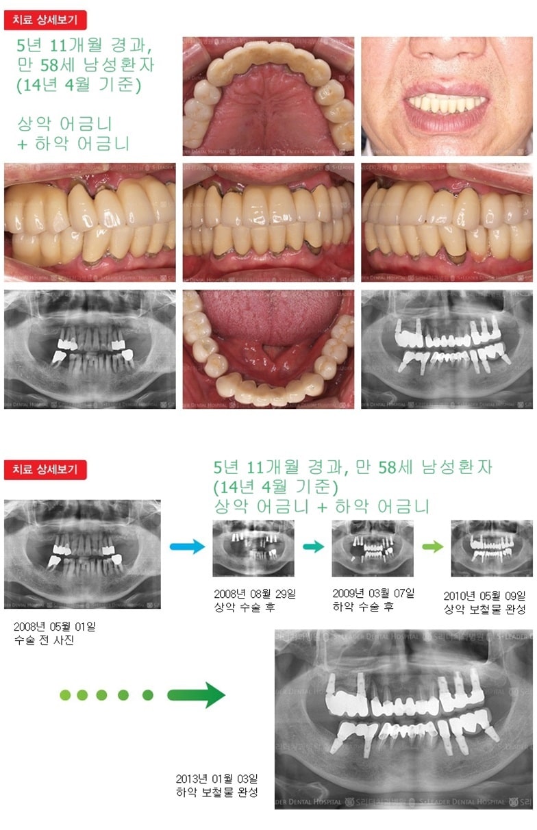 상악 어금니 +  하악 어금니 — 추가 사진 (임플란트)