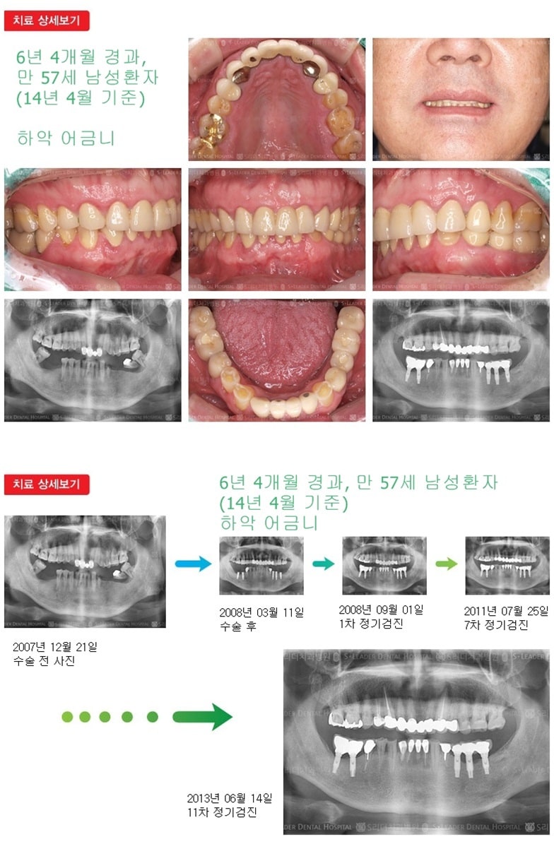하악어금니 18년 9개월 경과 — 추가 사진 (임플란트)