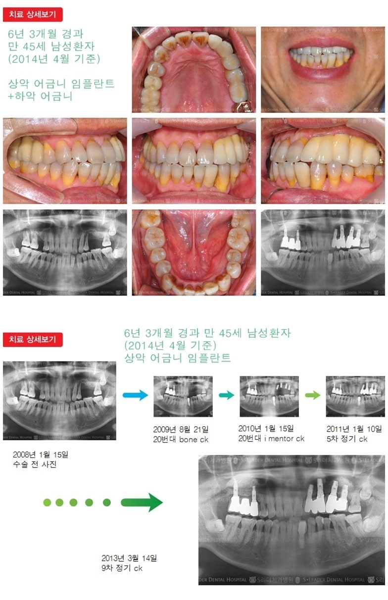 상악어금니+하악어금니18년 8개월 — 추가 사진 (임플란트)