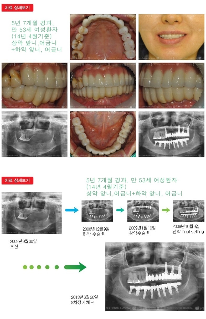 상악 전체, 하악 전체 18년 경과 — 추가 사진 (임플란트)