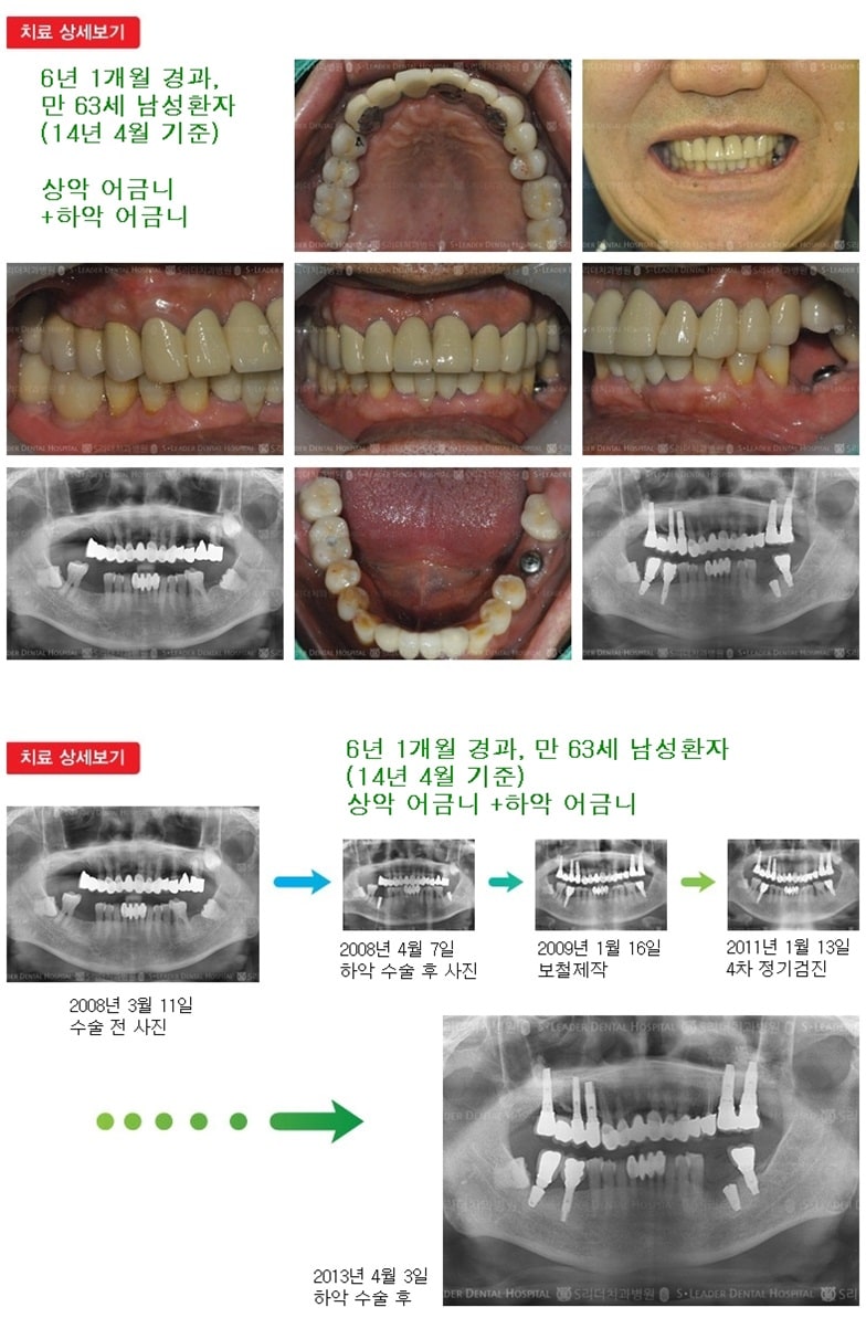 상악 어금니,하악 어금니,18년 6개월 경과 — 추가 사진 (임플란트)