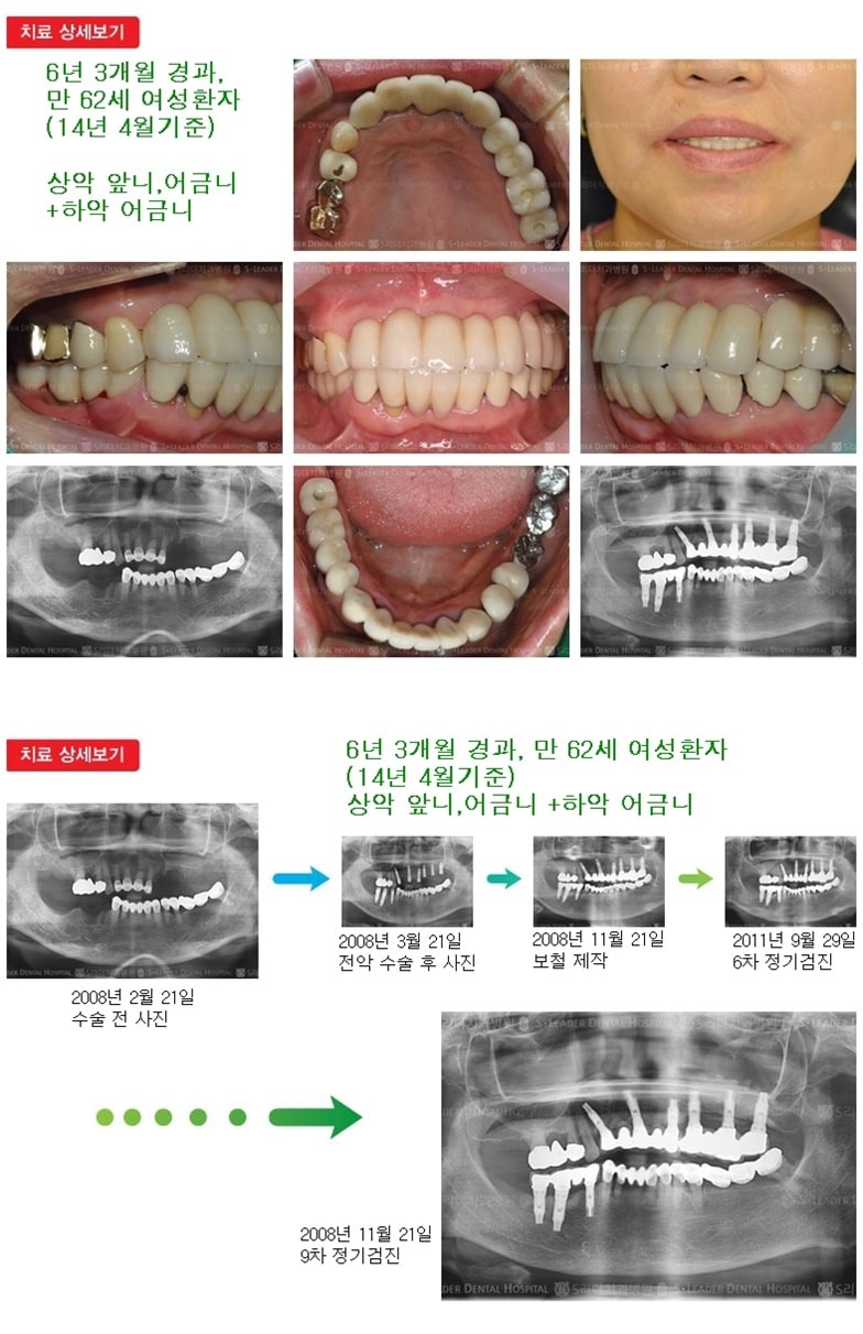 상악 앞니,어금니+하악 어금니 — 추가 사진 (임플란트)
