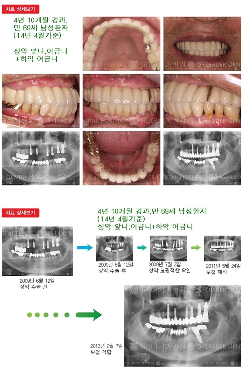 상악 앞니,어금니+하악 어금니 — 추가 사진 (임플란트)