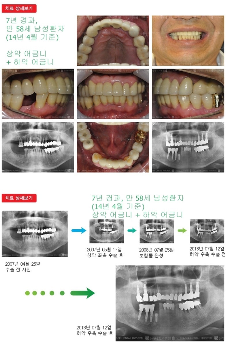 상악 어금니 +  하악 어금니 — 추가 사진 (임플란트)