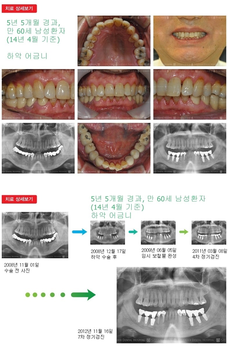 어금니임플란트, 17년 10개월 경과 — 추가 사진 (임플란트)