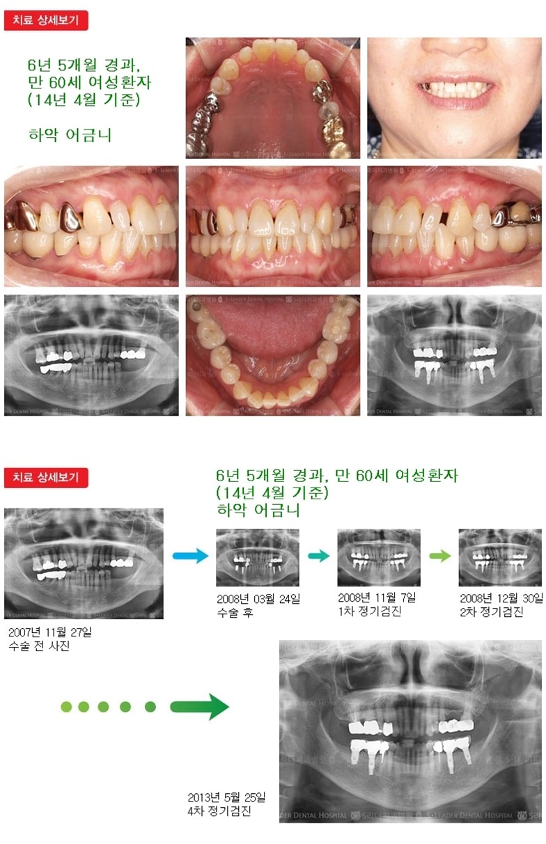 하악 어금니,18년 10개월경과 — 추가 사진 (임플란트)
