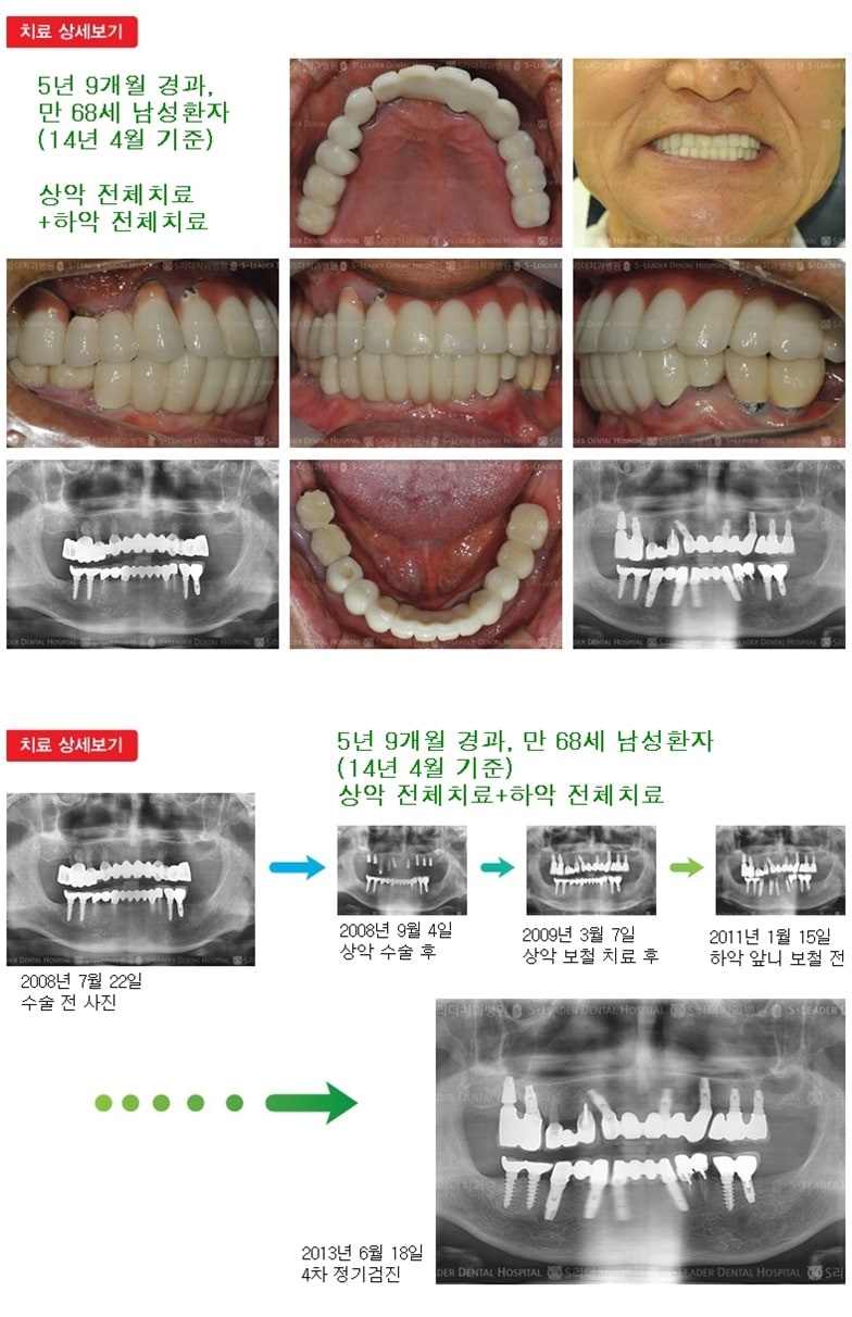 상악전체,하악전체,18년 2개월경과 — 추가 사진 (임플란트)