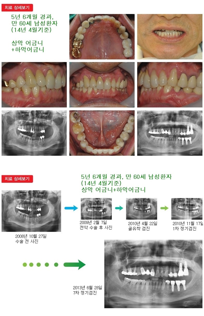 상악어금니하악어금니17년 11개월경과 — 추가 사진 (임플란트)