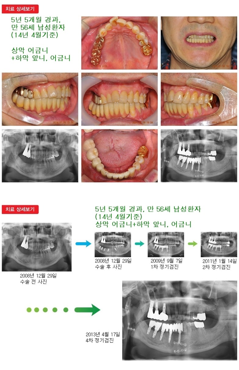 상악어금니+ 하악 앞니,어금니 — 추가 사진 (임플란트)