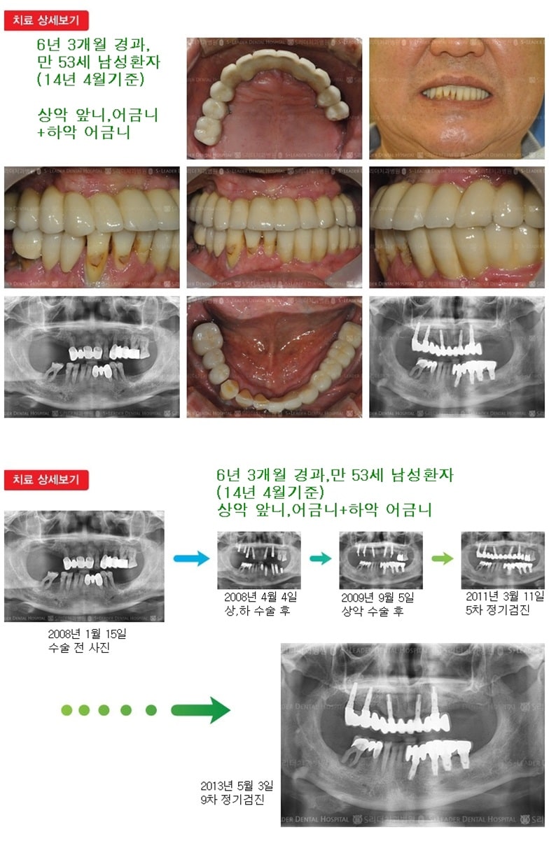 상악 앞니,어금니+하악 어금니 — 추가 사진 (임플란트)